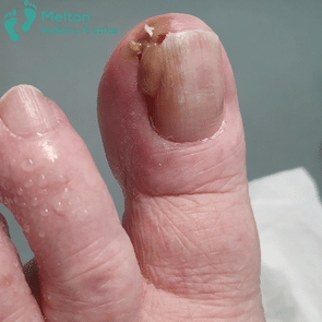Ingrowing toenail